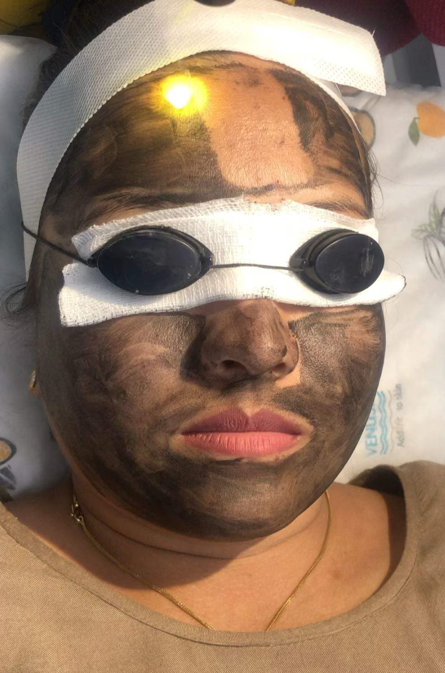 Carbon Laser Peel