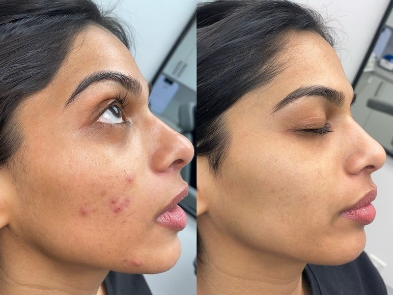 Acne & Scar Therapy